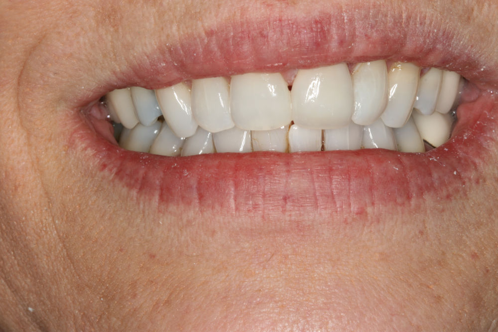 NJ Dental Restorations | See Our Oral Reconstruction Work