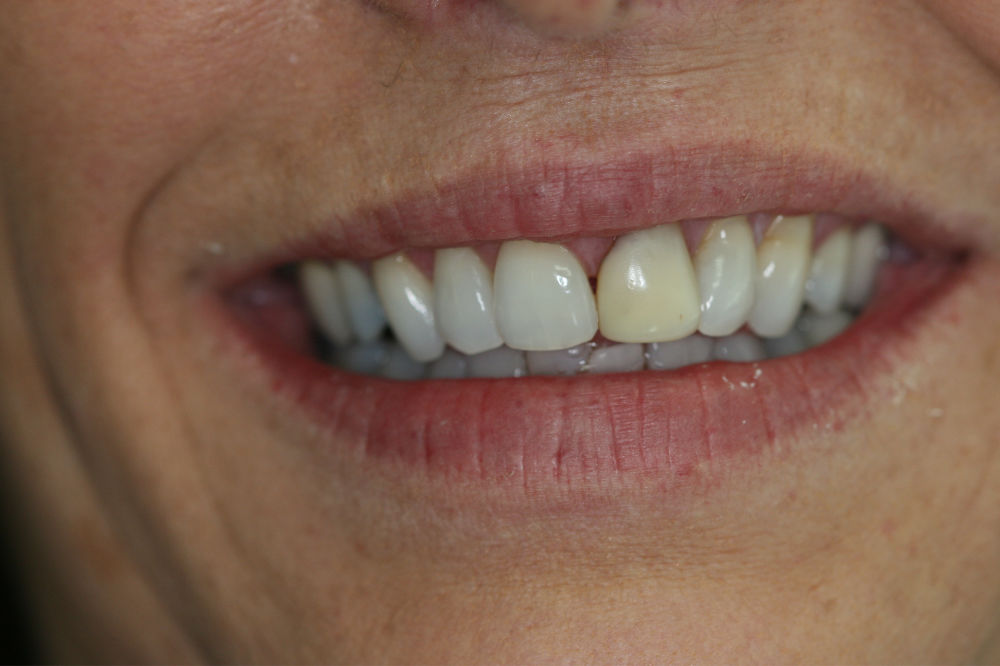 NJ oral restorations