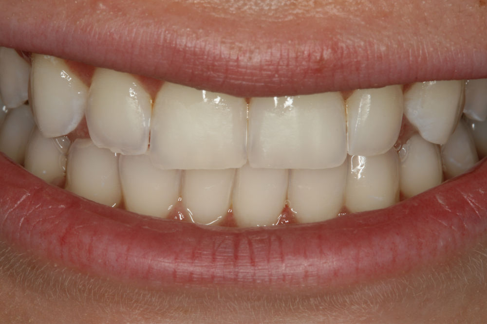 top oral restorations