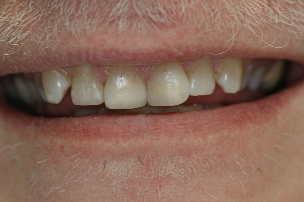 full mouth restoration dentistry