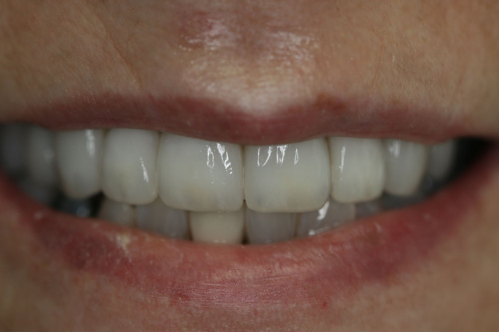 NJ smile restorations