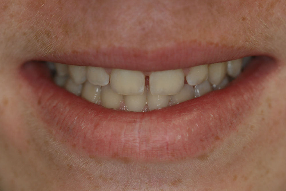 oral restoration before